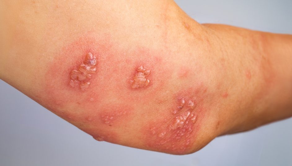 scabies on an elbow